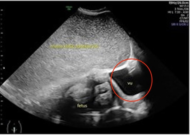 Thai phụ 26 tuổi kêu đau dạ dày, bác sĩ sốc nặng khi phát hiện "bí mật" đáng sợ - Ảnh 1.