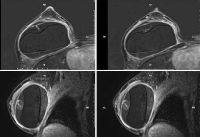 Hình MRI của bà Thắm cho thấy khối máu tụ bên trong ngực của bệnh nhân. Ảnh: Bệnh viện Đa khoa Tâm Anh