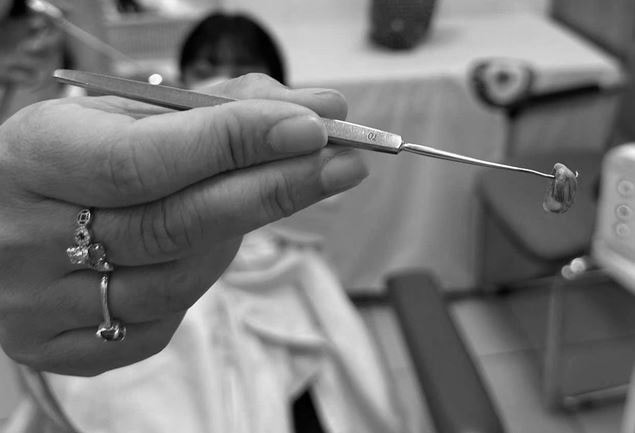 Bé 3 tuổi chảy nước mũi có mùi hôi khó chịu, bác sĩ gắp ra thứ "đáng sợ" bên trong- Ảnh 1. Bé 3 tuổi chảy nước mũi có mùi hôi khó chịu, bác sĩ gắp ra thứ "đáng sợ" bên trong- Ảnh 1.