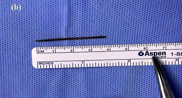 Người đàn ông 29 tuổi đau bụng dữ dội, bác sĩ sốc nặng khi phát hiện "bí mật" đáng sợ- Ảnh 2. Người đàn ông 29 tuổi đau bụng dữ dội, bác sĩ sốc nặng khi phát hiện "bí mật" đáng sợ- Ảnh 2.