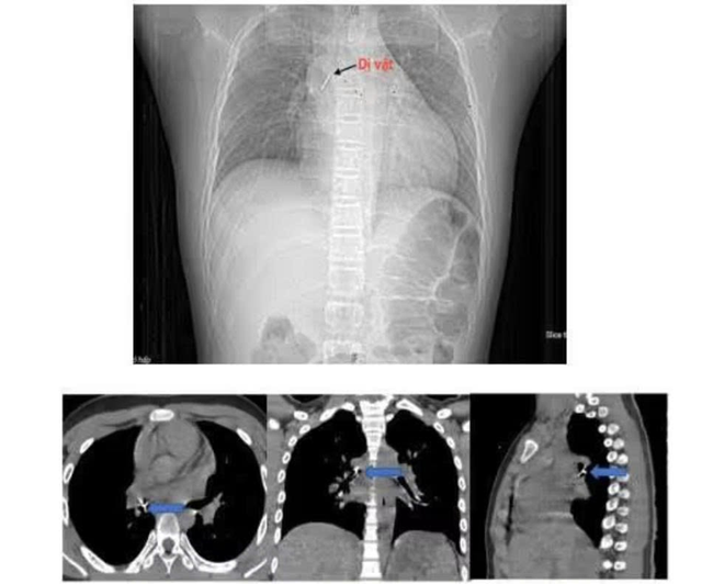 Bé trai 13 tuổi ho sặc sụa, bác sĩ gắp ra thứ "đáng sợ" bên trong  - Ảnh 1.
