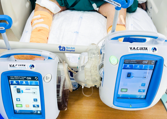Điều trị VAC liên tục cho người bệnh ở khoa ICU. Ảnh: Bệnh viện Đa khoa Tâm Anh