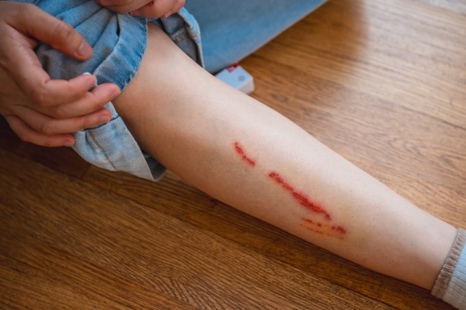 Vết thương chó cắn nhiễm trùng tiềm ẩn nhiều biến chứng nguy hiểm nếu không xử trí kịp thời. Ảnh minh họa: Vecteezy