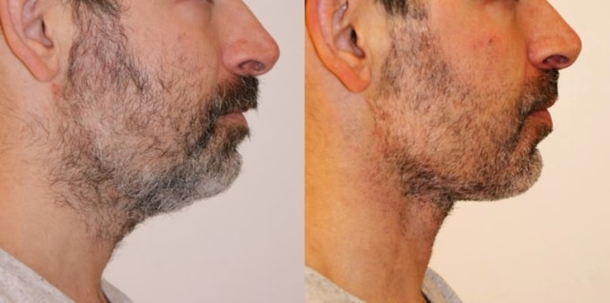 Kỹ sư công nghệ chi trăm nghìn USD căng da vì sợ bị hết thời/Dân công nghệ Thung lũng Silicon đổ xô đi phẫu thuật thẩm mỹ - 1