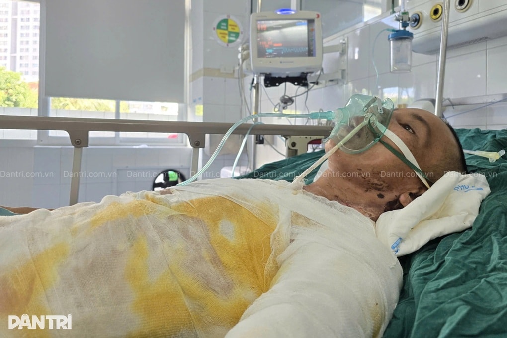 Ngã vào chảo mỡ bò đang sôi, người bố 2 con bỏng 75% cơ thể - 2 Ngã vào chảo mỡ bò đang sôi, người bố 2 con bỏng 75% cơ thể - 2