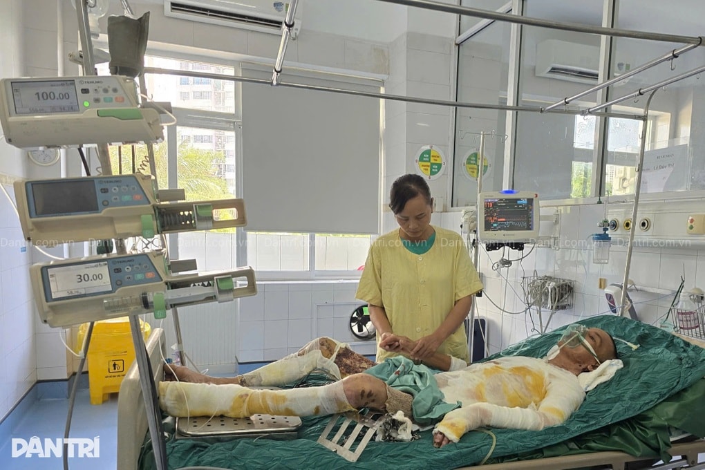 Ngã vào chảo mỡ bò đang sôi, người bố 2 con bỏng 75% cơ thể - 5 Ngã vào chảo mỡ bò đang sôi, người bố 2 con bỏng 75% cơ thể - 5