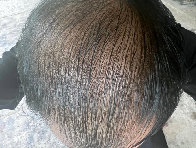 Một người đàn ông bị rụng tóc, vùng đỉnh đầu hói dần. Ảnh: Nhân vật cung cấp