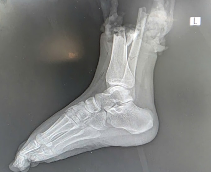 Hình ảnh chụp phần chi thể đứt rời. Ảnh: Bệnh viện cung cấp