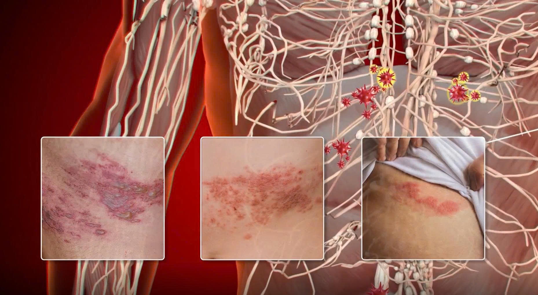 Vaccine thủy đậu có phòng được bệnh zona thần kinh?