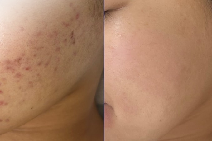 Sau hai tháng điều trị kết hợp đa tầng, các sẹo mụn trên mặt Trâm giảm đáng kể. Ảnh: Bệnh viện Đa khoa Tâm Anh