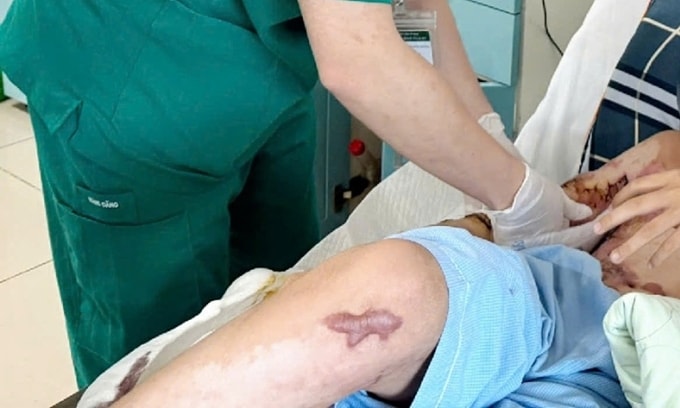 Một bệnh nhân bị di chứng sẹo co kéo điều trị tại Bệnh viện Bạch Mai. Ảnh: Nguyên Hà