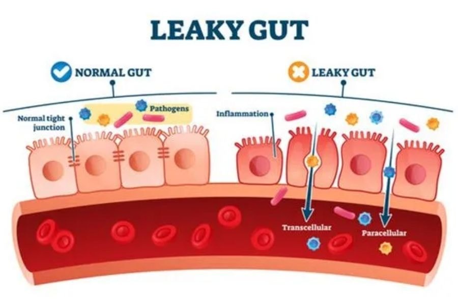 Hội chứng rò rỉ ruột (Park Cities Neuropathy & Wellness)