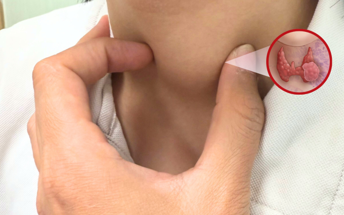 Khối sưng bất thường vùng cổ bệnh nhi. Ảnh: BVĐK Hồng Ngọc