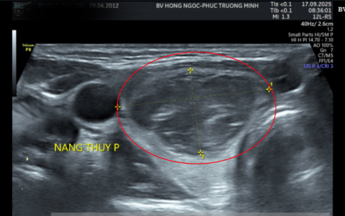 Kết quả siêu âm cho thấy khối u lớn hơn 3 cm. Ảnh: BVĐK Hồng Ngọc