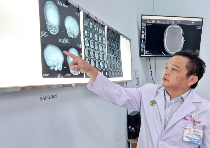 Bác sĩ Đô xem phim chụp của trẻ dị tật dính khớp sọ. Ảnh: Lê Phương