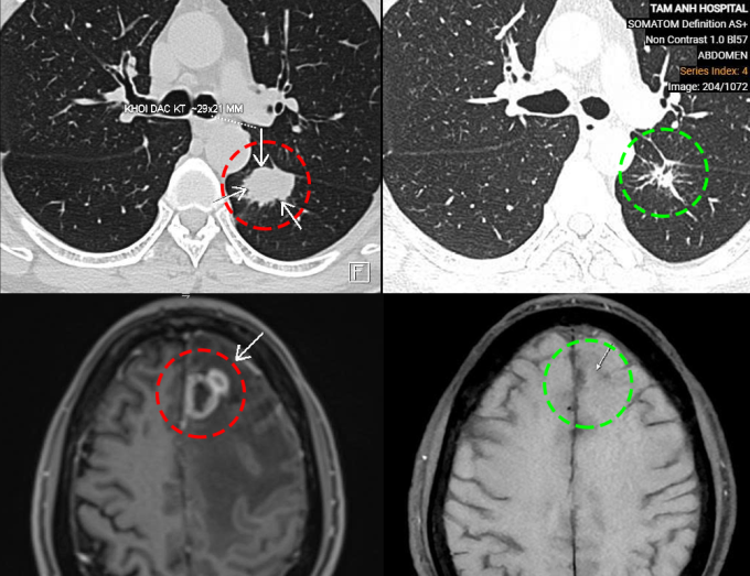 Khối u ở phổi và não của ông Chung trước điều trị (bên trái) và sau điều trị (bên phải). Ảnh: Bệnh viện Đa khoa Tâm Anh