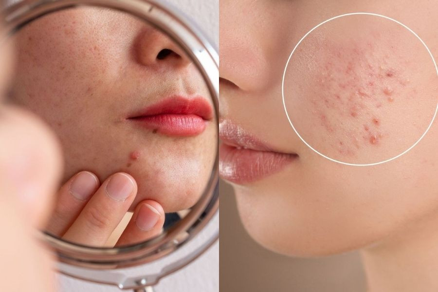 Mụn cứ tái phát, hãy kiểm tra sức khỏe đường ruột của bạn 