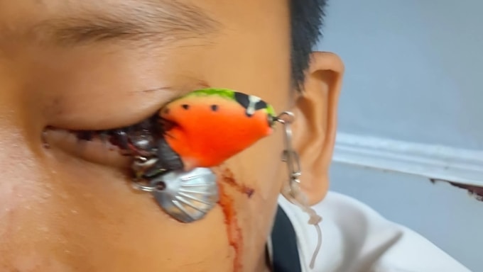 Móc câu mắc vào nhãn cầu bé trai. Ảnh: Bệnh viện cung cấp