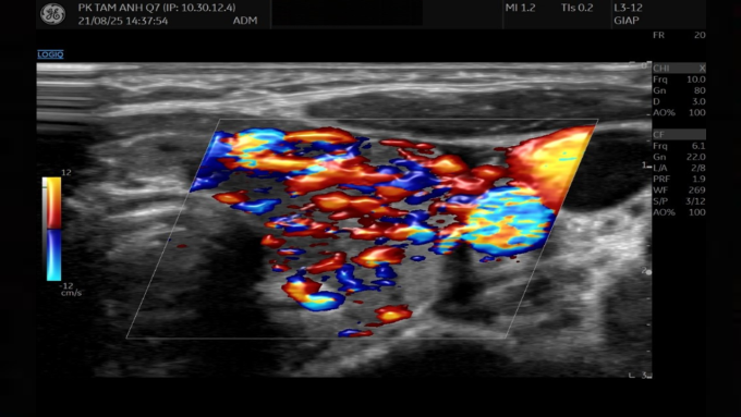 Kết quả siêu âm cho thấy nhu mô tuyến giáp không đồng nhất, tăng tưới máu. Ảnh: Phòng khám Đa khoa Tâm Anh Quận 7