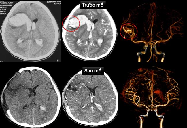 Hình ảnh chụp cắt lớp vi tính sọ não và dựng hình mạch máu não trước và sau mổ. Ảnh: Bệnh viện cung cấp