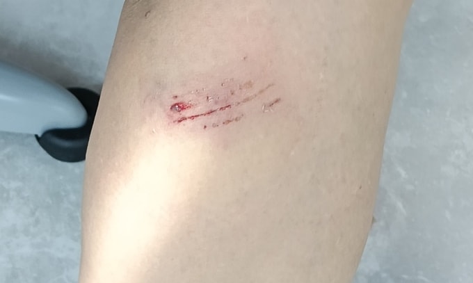 Vết thương ở chân bà Hạnh do bị chó nhà hàng xóm cắn. Ảnh: Khánh Hòa