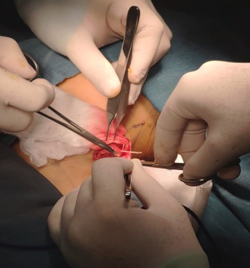 Người đàn ông suýt thủng phế quản vì mảnh xương cá đi lạc - Ảnh 1.