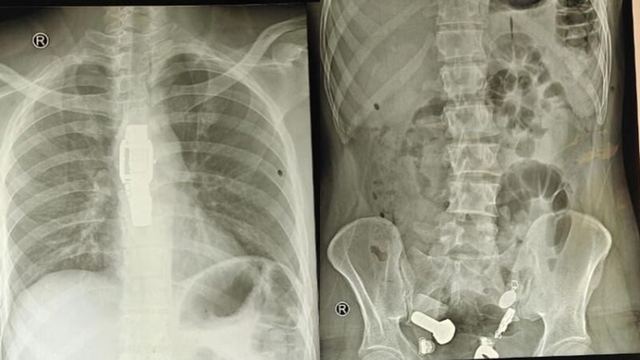 Người đàn ông liên tục đau bụng, bác sĩ sốc nặng khi phát hiện "bí mật" đáng sợ- Ảnh 1. Người đàn ông liên tục đau bụng, bác sĩ sốc nặng khi phát hiện "bí mật" đáng sợ- Ảnh 1.