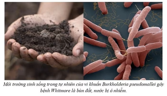 Người đàn ông suýt mất mạng vì vi khuẩn hiếm gặp trong bùn đất sau lũ - Ảnh 3.