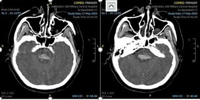 Hình chụp CT não một bệnh nhân đột quỵ do tăng huyết áp. Ảnh: Bệnh viện cung cấp