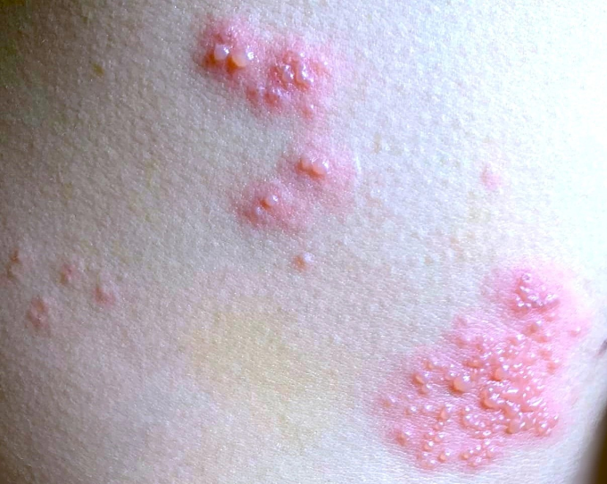 Bóng nước trên da của người mắc zona thần kinh. Ảnh: Diệu Thuần