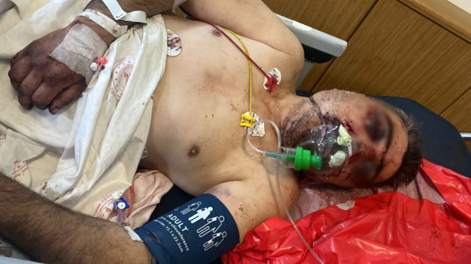 Kadir Bicer được đưa tới bệnh viện trong tình trạng nguy kịch, phải hôn mê điều trị và trải qua nhiều tuần trong phòng hồi sức. Ảnh: Sun