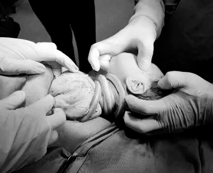 Em bé chào đời với 6 vòng dây rốn quấn cổ. Ảnh: Bệnh viện cung cấp