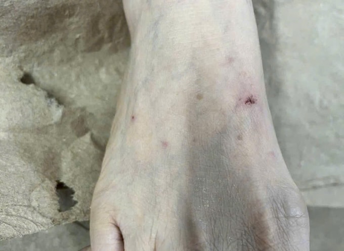 Bị mèo nhà cắn, bệnh nhân tự xử trí sai cách bằng việc nặn máu và bôi nước chanh lên vết thương. Ảnh: Bệnh viện cung cấp