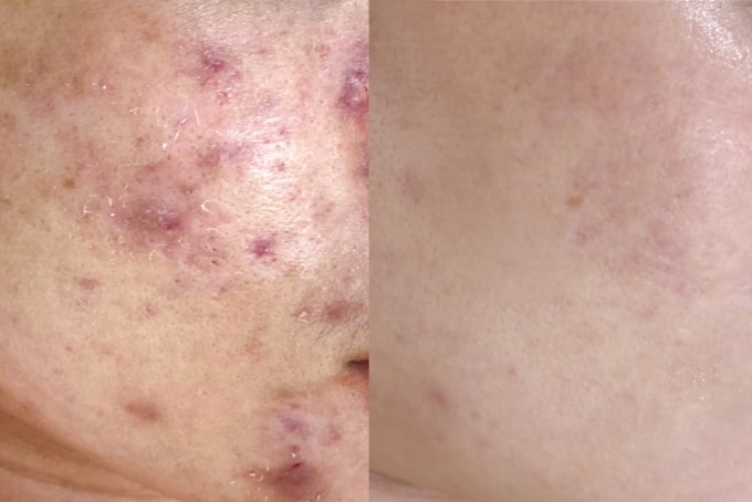 Mụn viêm của chị Hằng dần cải thiện sau một năm kiên trì điều trị. Ảnh: Bệnh viện Đa khoa Tâm Anh