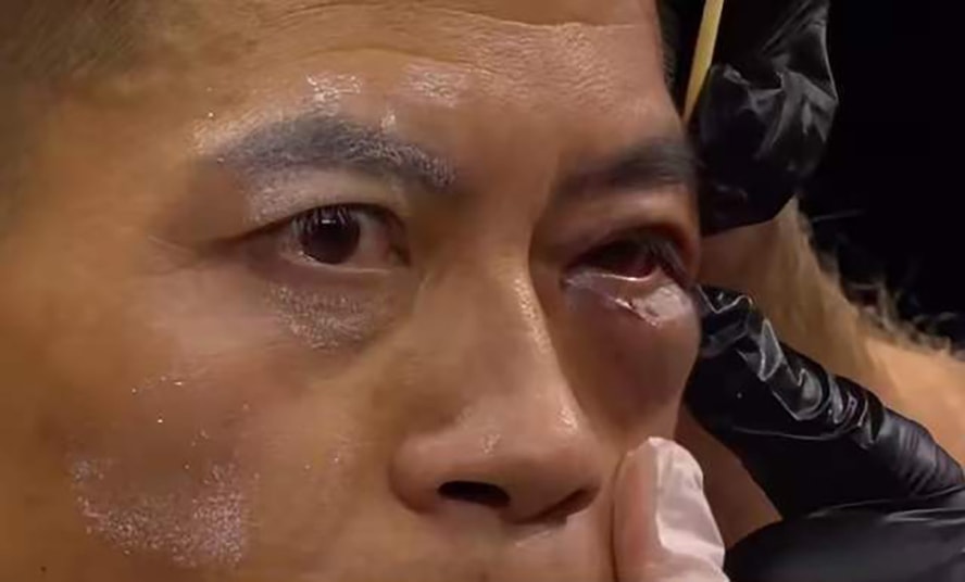 Mắt của Triệu Hồng Cương thâm tím sau cú tát đầu tiên của Mukhammed Amantayev