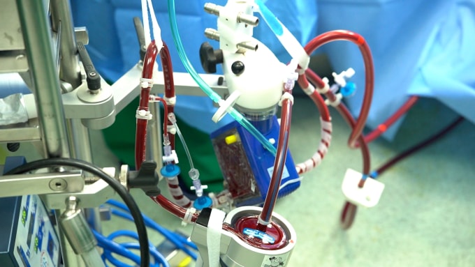 Hệ thống ECMO được duy trì trong suốt cuộc mổ cũng như quá trình hậu phẫu của bệnh nhân. Ảnh: Bệnh viện cung cấp