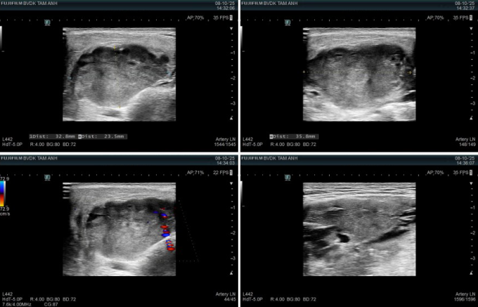 Ảnh siêu âm ghi nhận khối u tuyến mang tai bên phải của anh Thành. Ảnh: Bệnh viện Đa khoa Tâm Anh