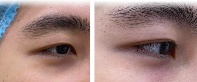 Phần trũng mắt của Thắng đã được cải thiện sau tiêm HA. Ảnh: Phòng khám Đa khoa Tâm Anh Quận 7