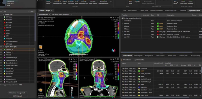 AI mô phỏng lập kế hoạch xạ trị cho một ca ung thư. Ảnh: Bác sĩ cung cấp