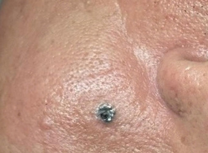 Nốt ruồi của ông Lượng gồ nhẹ, sần ráp, mật độ chắc. Ảnh: Bệnh viện Đa khoa Tâm Anh