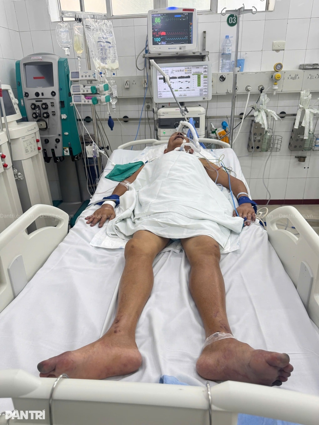 Vợ ung thư gục ngã khi chồng nguy kịch trong phòng hồi sức - 2 Vợ ung thư gục ngã khi chồng nguy kịch trong phòng hồi sức - 2