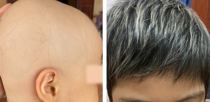 Bé gái mọc lại tóc sau điều trị. Ảnh: Bệnh viện cung cấp