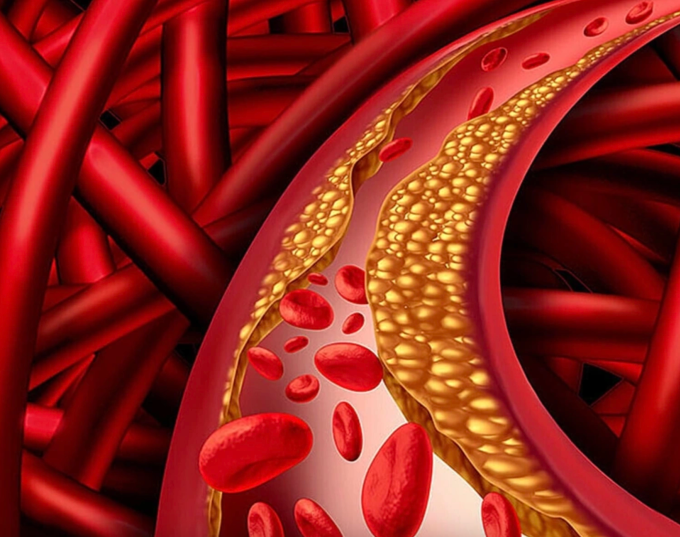 Minh họa cholesterol tích tụ trong máu. Ảnh: My Health My Life