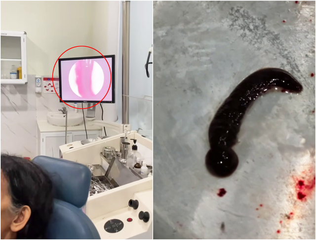 Cụ bà 72 tuổi ngứa mũi liên tục, bác sĩ gắp ra thứ "đáng sợ" bên trong - Ảnh 1.