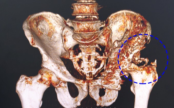 Phim chụp CT ổ nhiễm trùng gây tiêu xương nặng của ông Trúc. Ảnh: Bệnh viện Đa khoa Tâm Anh