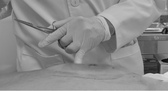 Vết thương trên lưng chị Lý sưng tấy, nhiễm trùng lan rộng. Ảnh: Bệnh viện Đa khoa Tâm Anh