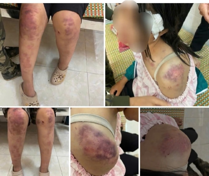 Bé gái bị thương tích khắp người. Ảnh: Quỳnh Trang