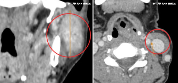 Ảnh chụp CT ghi nhận khối u lớn vùng mang tai trái của chị Dương. Ảnh: Bệnh viện Đa khoa Tâm Anh
