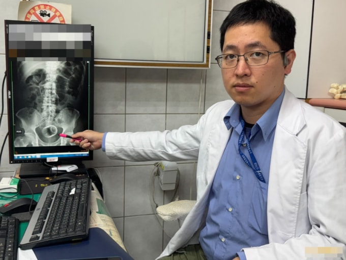 Chiếc cốc sứ làm thủng ruột người đàn ông, gây hoại tử và táo bón 3 ngày