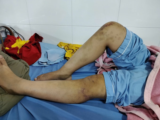 Hiện bé vẫn nằm viện trong tình trạng tím khắp người. Ảnh: Linh Đan